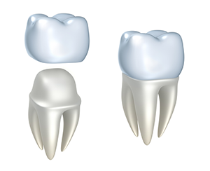 illustration of crown fitting over tooth, dental crowns Zebulon, NC